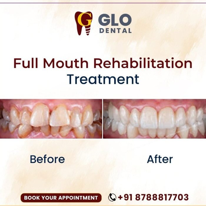 glo-dental-implant-clinic-hinjewadi-phase-1-pune-dental-clinics-b103tdqu2w